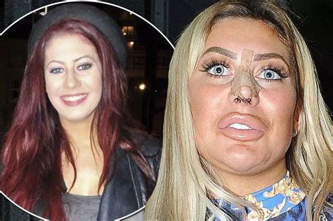 chloe ferry before surgery|geordie shore before and after.